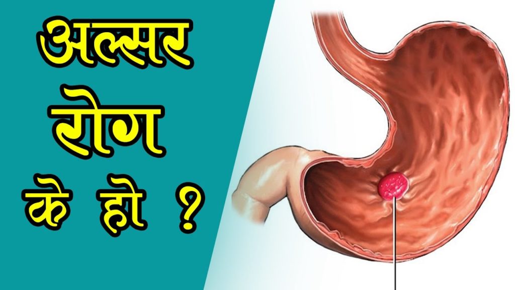 अल्सर कस्तो रोग हो ? यो कसरि थाहा पाउने ? – Kalika News